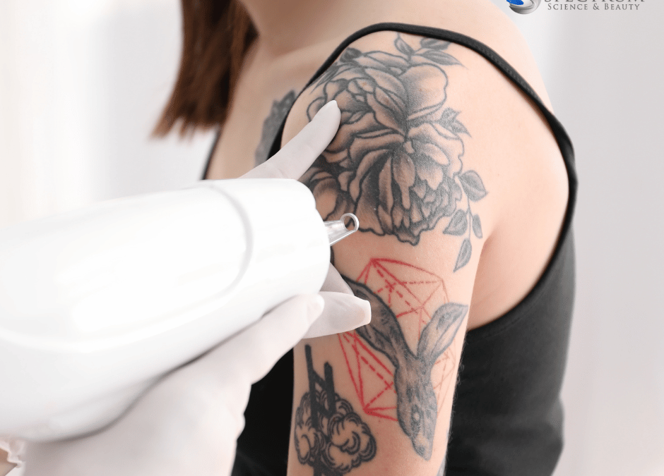 tattoo removal insights