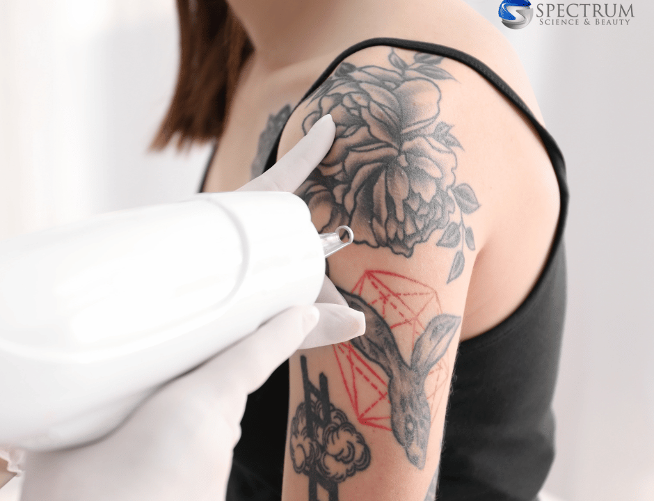 tattoo removal insights